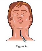Excerpt from a diagram of a tracheotomy.